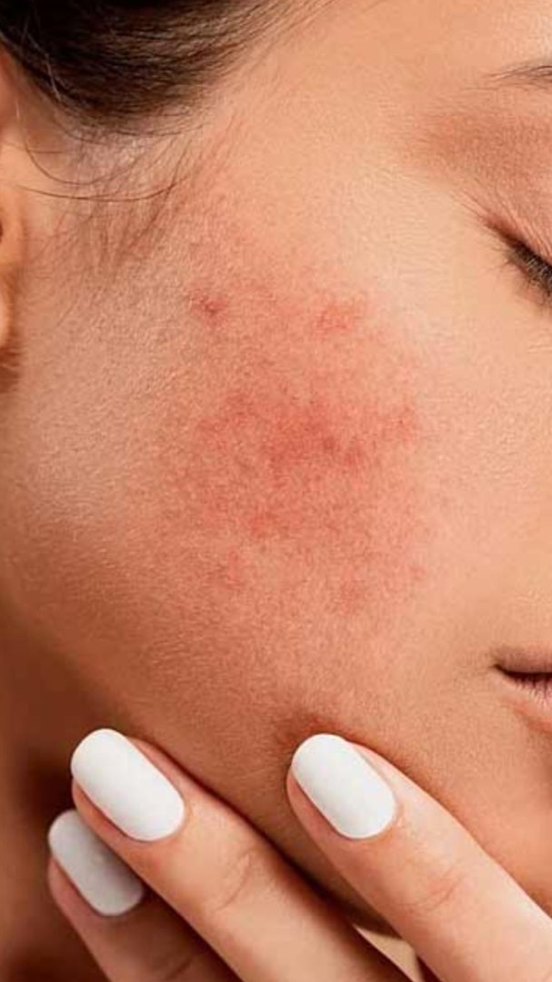 Melasma